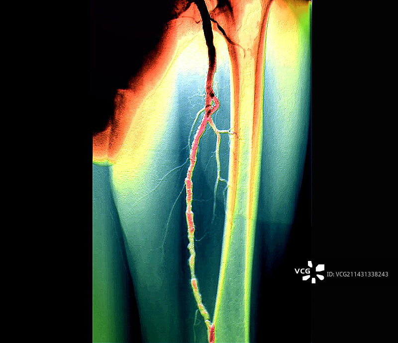 动脉粥样硬化，X光片图片素材