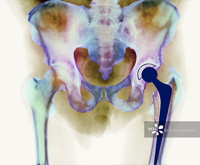 髋关节置换X光片图片素材