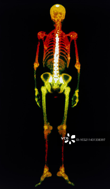 人体骨骼的彩色伽玛扫描图片素材