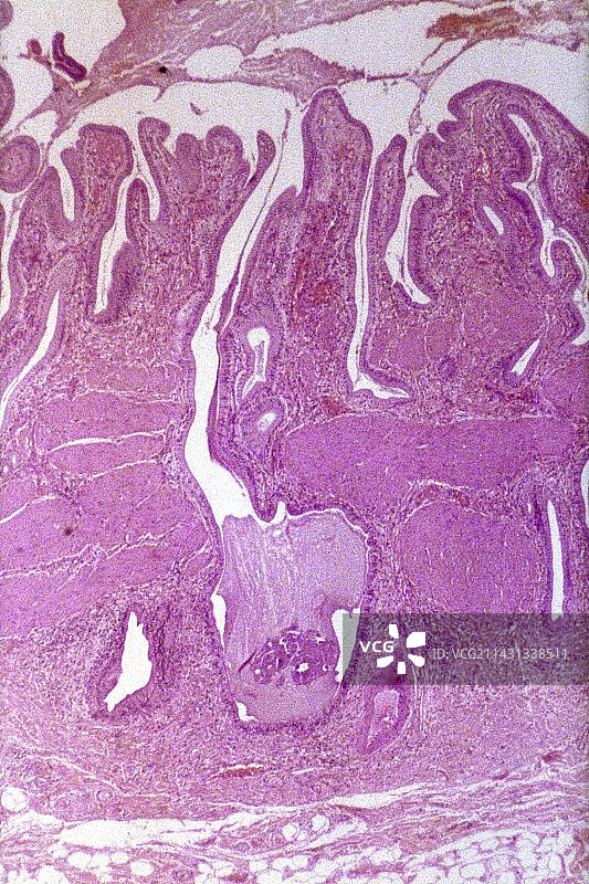 胆管癌显微照片图片素材