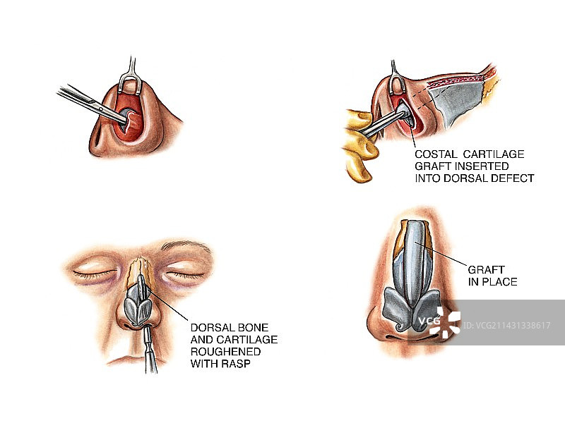 隆鼻重建手术图片素材