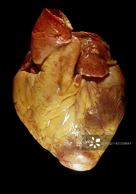 心淀粉样变性图片素材