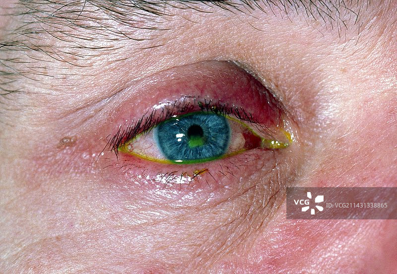 荧光素染色的角膜磨损图片素材