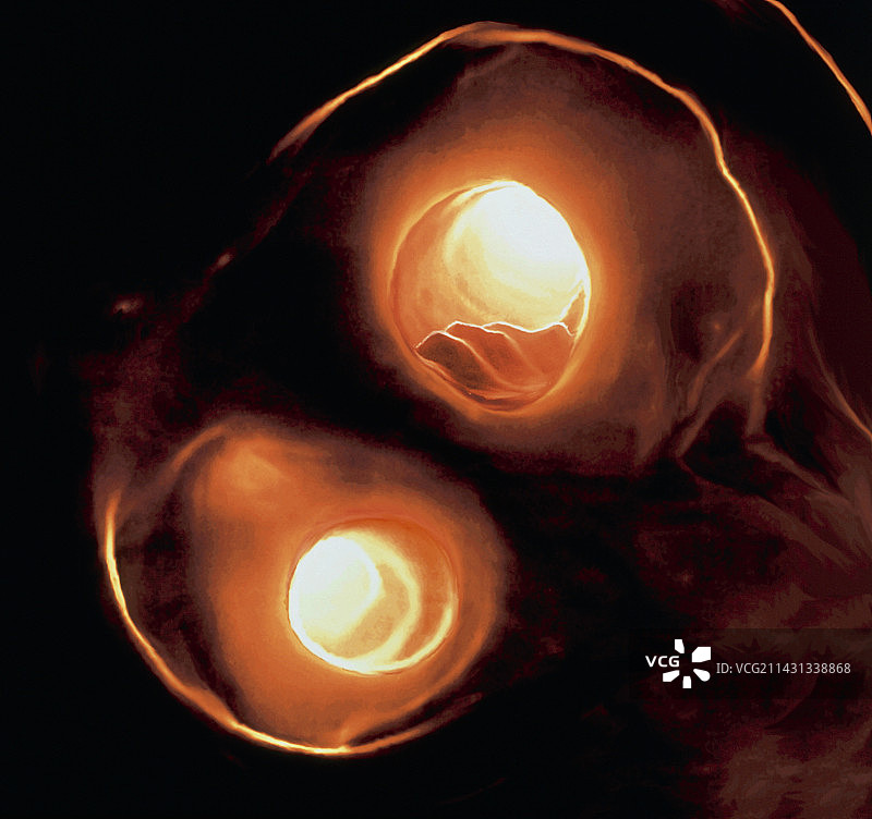 颈动脉动脉粥样硬化图片素材