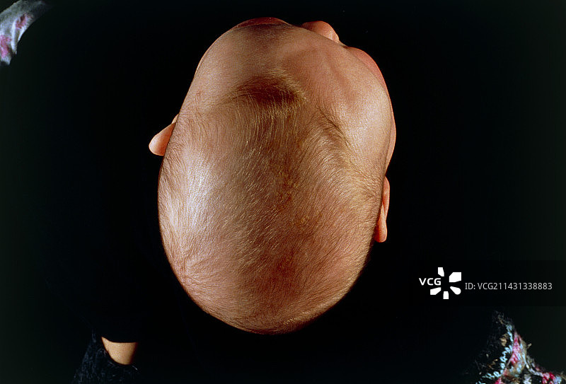 婴儿的斜头畸形图片素材