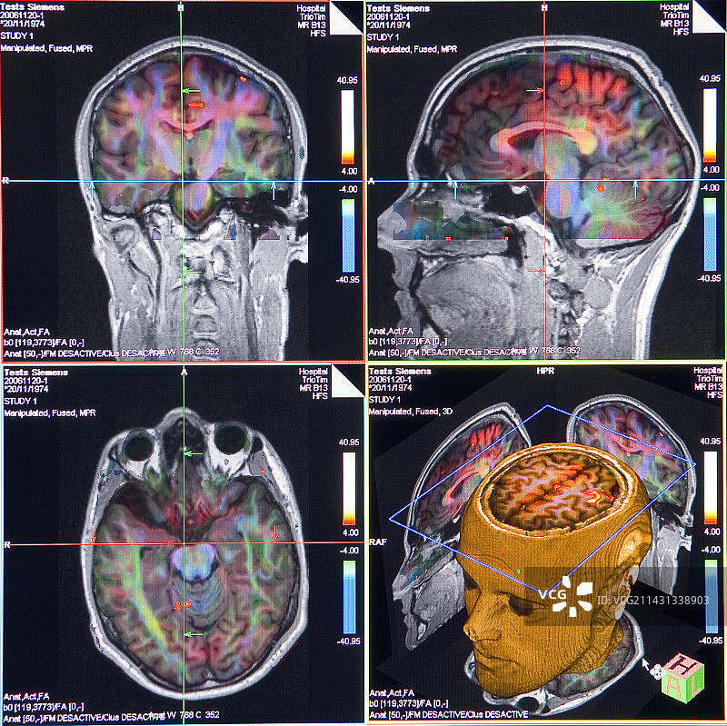 高级脑部MRI扫描图片素材