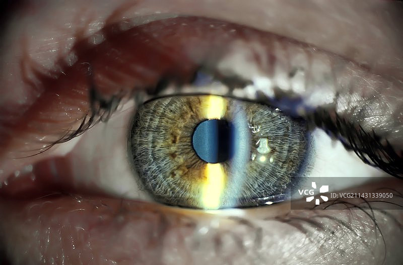 裂隙灯眼科检查图片素材