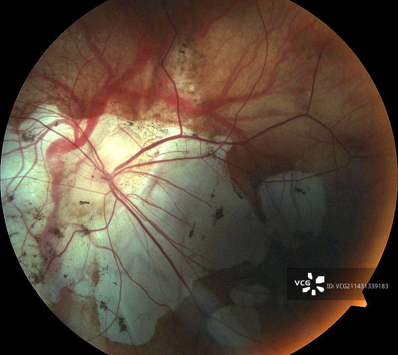 马凡综合征眼底照片图片素材
