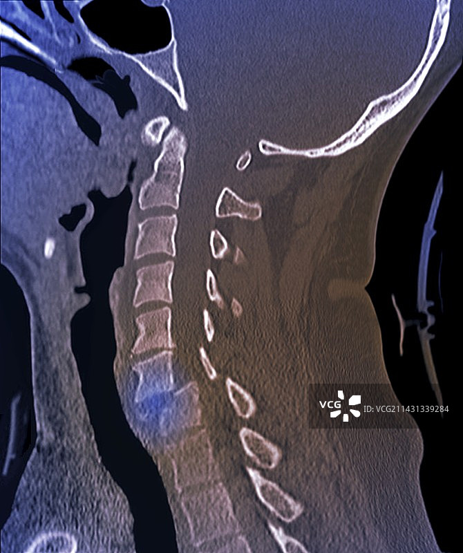 颈部挥鞭伤，CT扫描图片素材