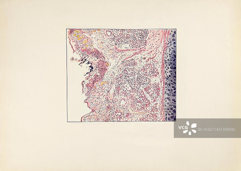西班牙流感造成的呼吸道损伤图片素材