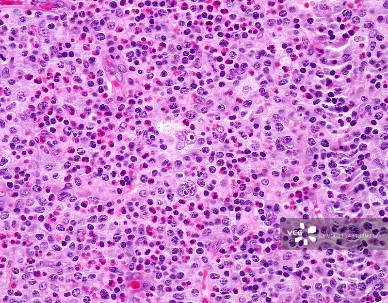 外周T细胞淋巴瘤显微照片图片素材