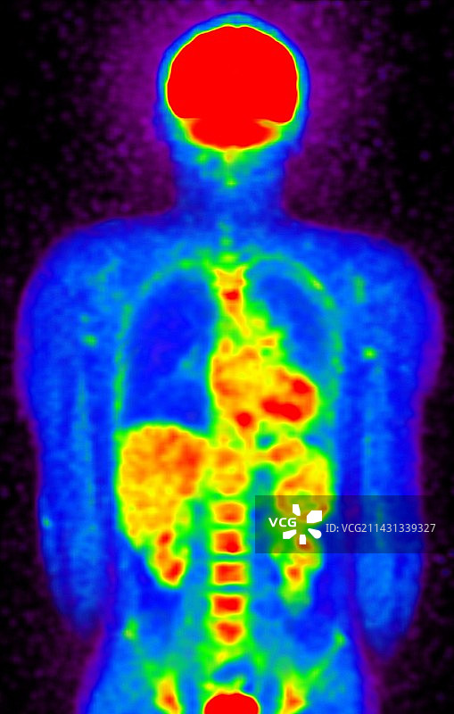 人体PET-CT扫描图片素材