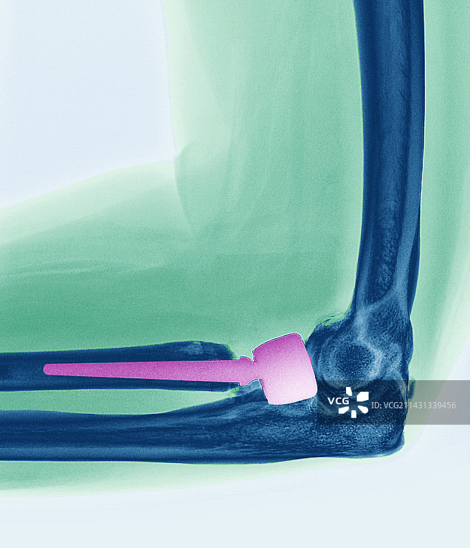 假肢肘关节X光片图片素材