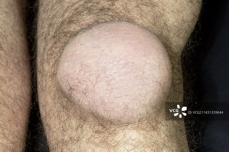 膝盖髌前滑囊炎图片素材