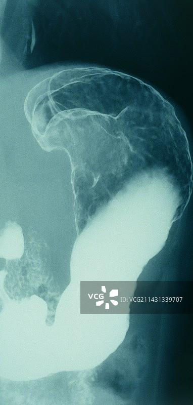 胃癌，钡餐X光图片素材