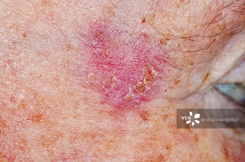 日光性角化病图片素材