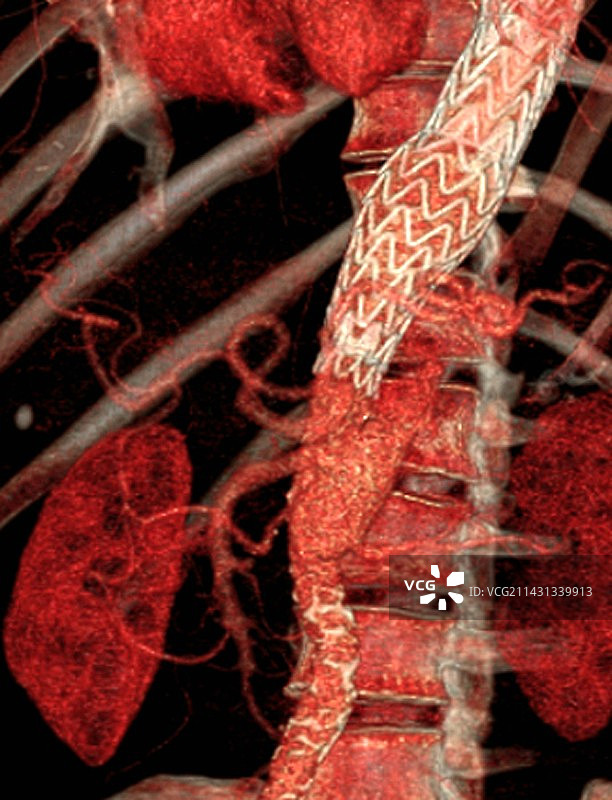 主动脉夹层中的支架，3D CT血管造影图片素材