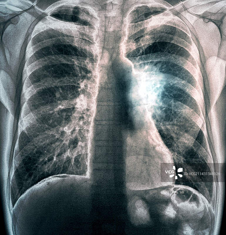 肺癌X光片图片素材
