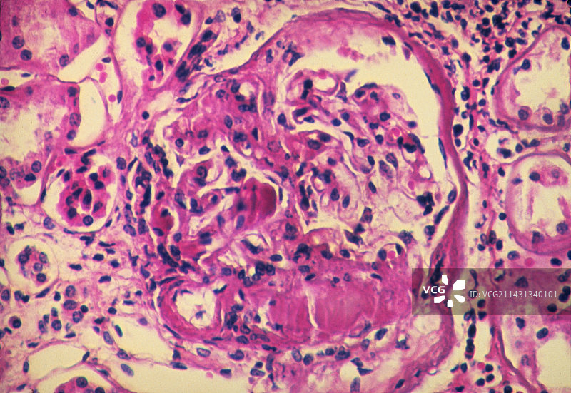 糖尿病肾脏肾小球的光学显微镜图像图片素材