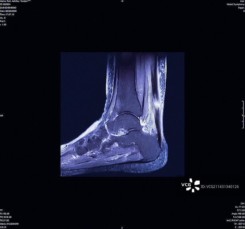 跟腱撕裂，核磁共振图片素材