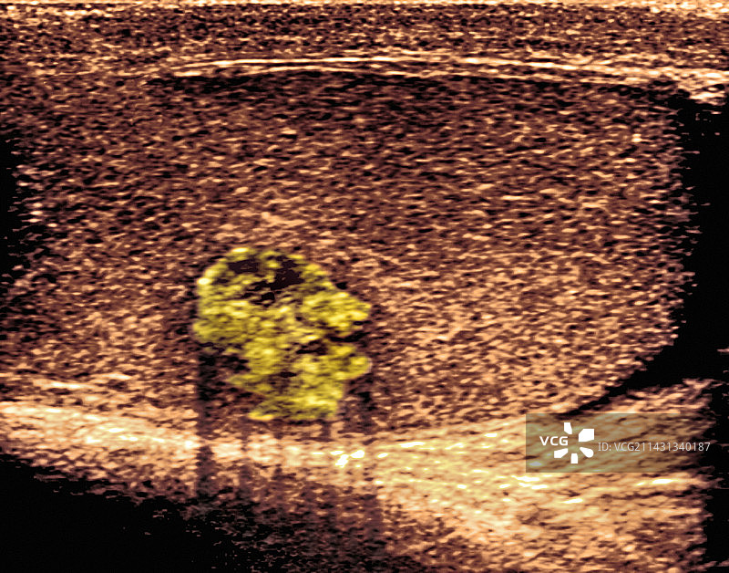 睾丸癌超声波扫描图片素材
