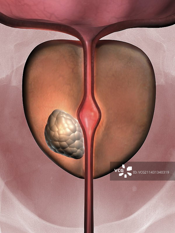 前列腺癌医学插图图片素材