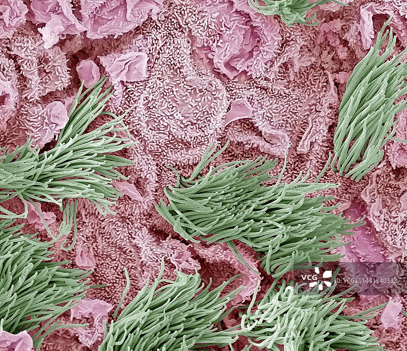 子宫癌扫描电镜图图片素材