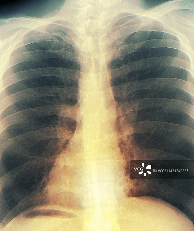 卡塔格纳综合征X光片图片素材