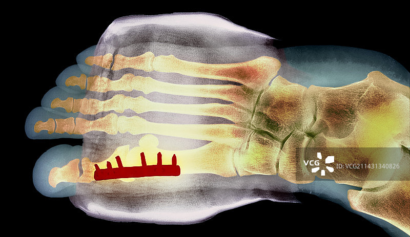 拇囊炎手术后的大脚趾X光片图片素材