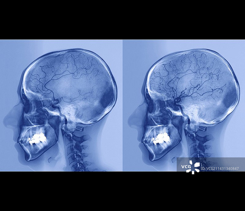 中风治疗：血管造影图片素材