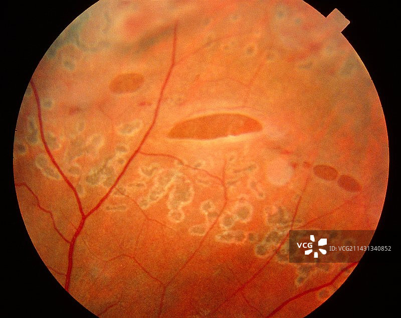 眼底镜下的视网膜撕裂图像图片素材