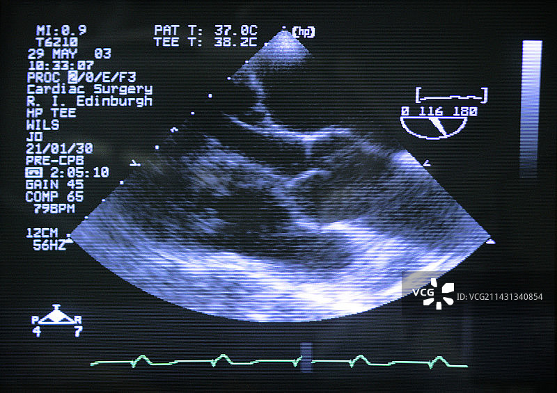 受损的主动脉瓣超声波扫描图片素材