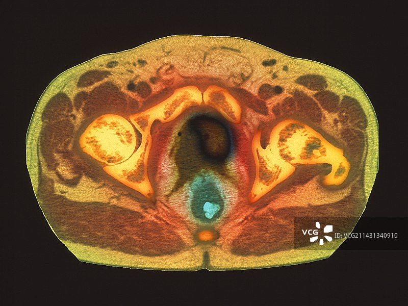 前列腺癌CT扫描图片素材