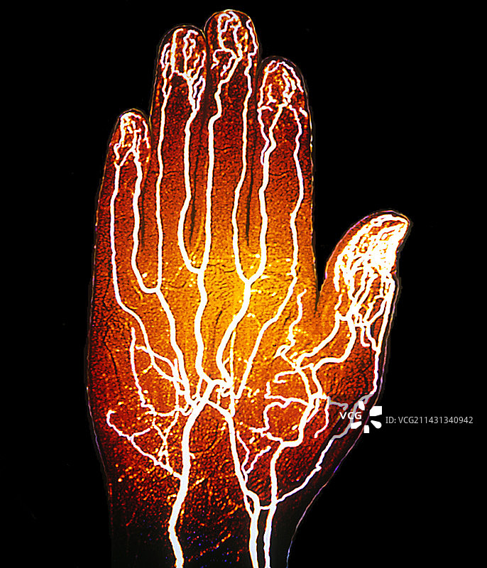 手部动脉X光片图片素材