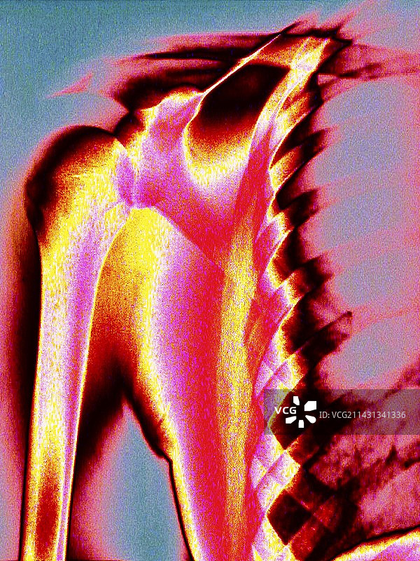 肩膀彩色X光片图片素材