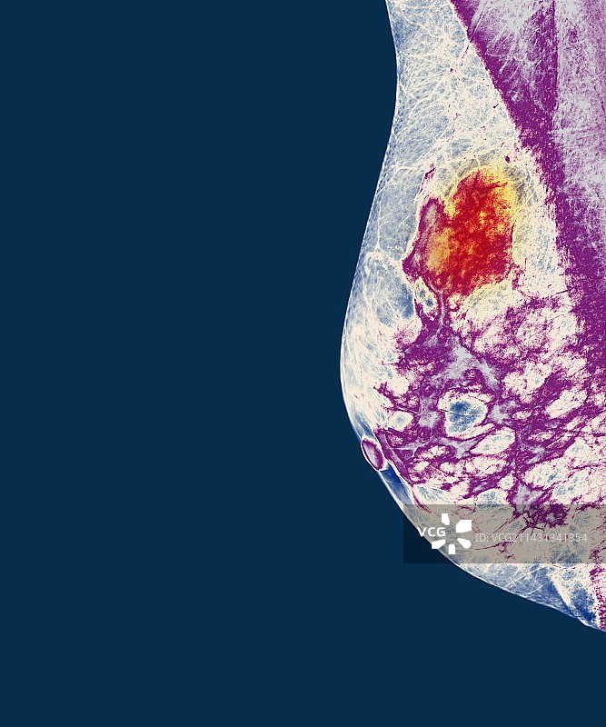 乳腺癌X光片图片素材