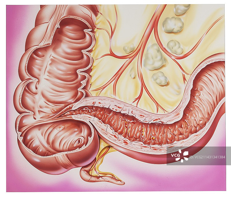克罗恩病插图图片素材