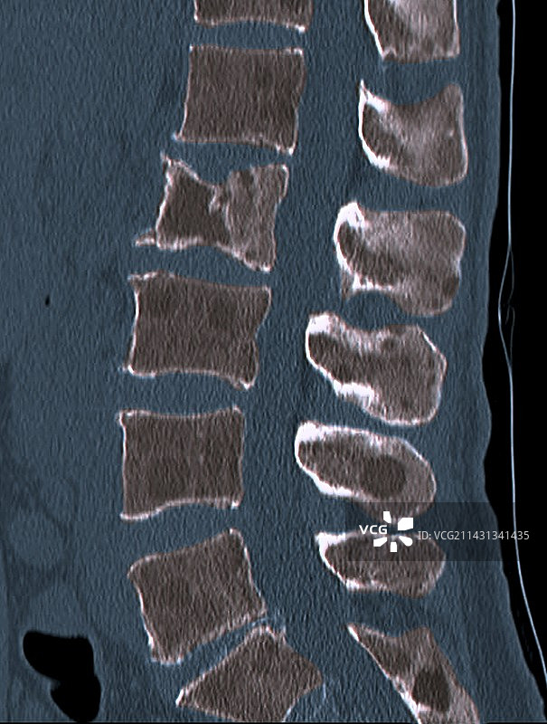 脊柱继发性骨癌CT扫描图片素材