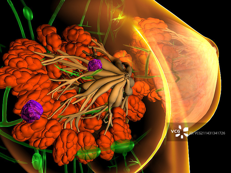 乳腺癌插图图片素材