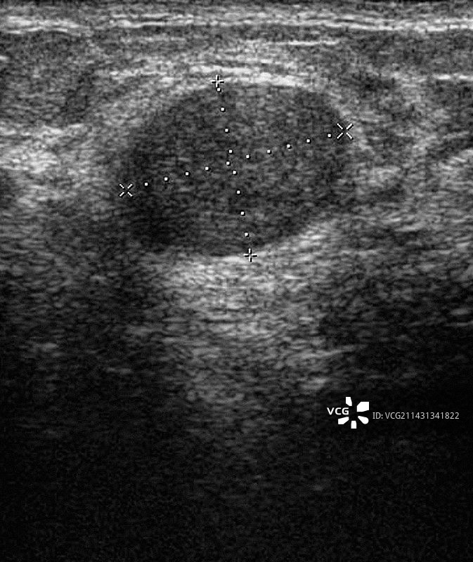 乳腺肿瘤超声波扫描图片素材