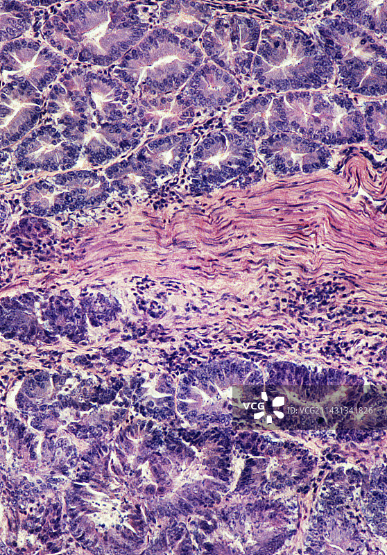 胃癌（胃）的显微照片图片素材