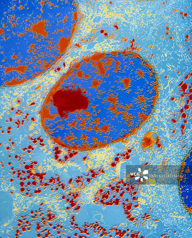 类癌（神经内分泌）肿瘤的彩色透射电镜图片素材