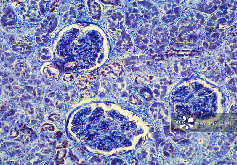 肾小球肾炎的LM图片素材