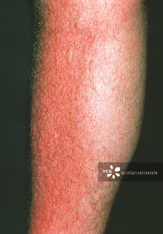 晒伤的小腿图片素材