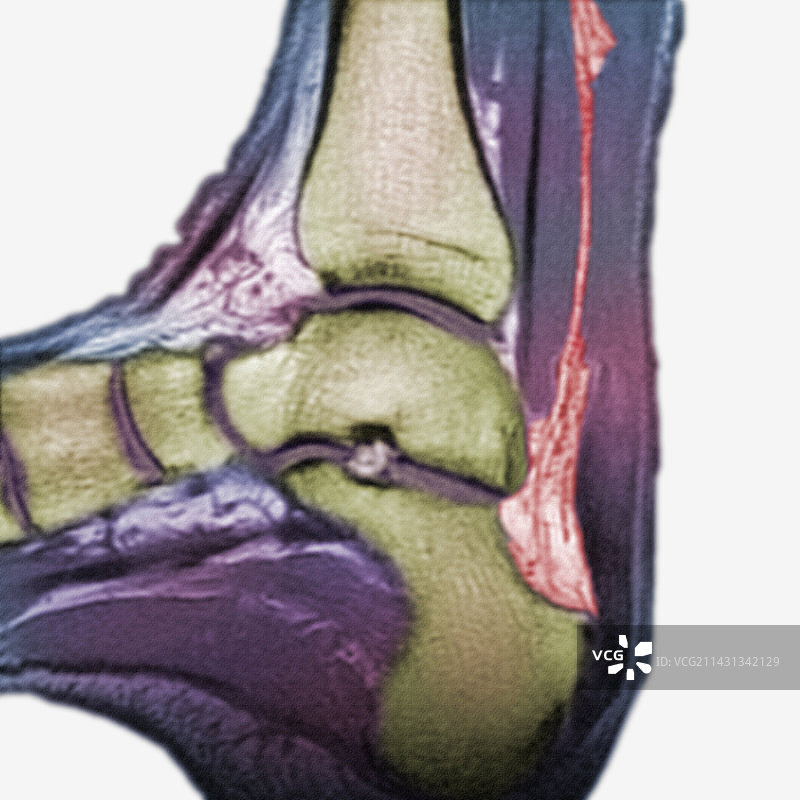 跟腱断裂的核磁共振图像图片素材