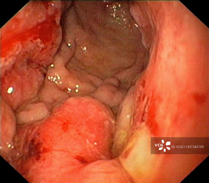 晚期胃癌图片素材