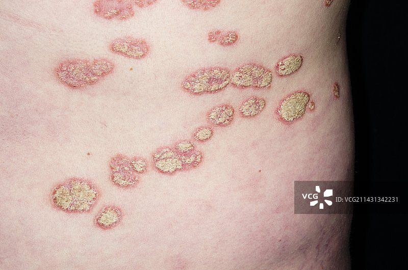 皮肤上的斑块状银屑病图片素材