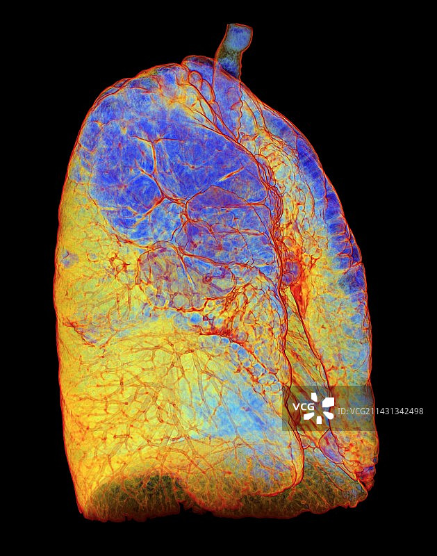 吸烟者肺部与肺气肿，3D CT扫描图片素材