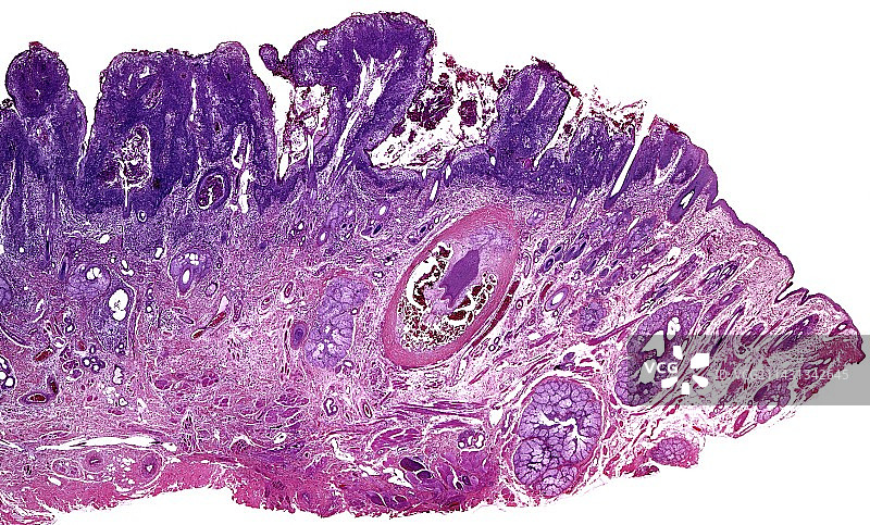鳞状细胞癌显微照片图片素材