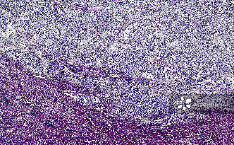胆管癌显微照片图片素材